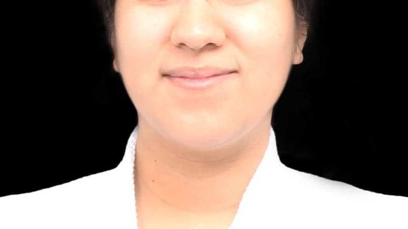 Chin Liposuction Before & After Gallery - Patient 366161 - Image 2