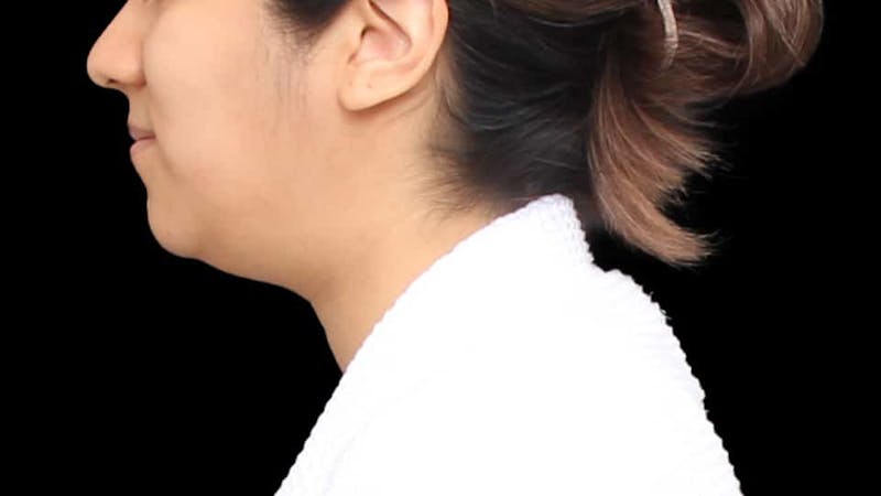Chin Liposuction Before & After Gallery - Patient 366161 - Image 3