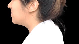 Chin Liposuction Before & After Gallery - Patient 366161 - Image 4