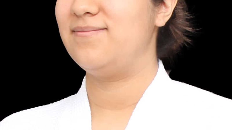 Chin Liposuction Before & After Gallery - Patient 366161 - Image 5