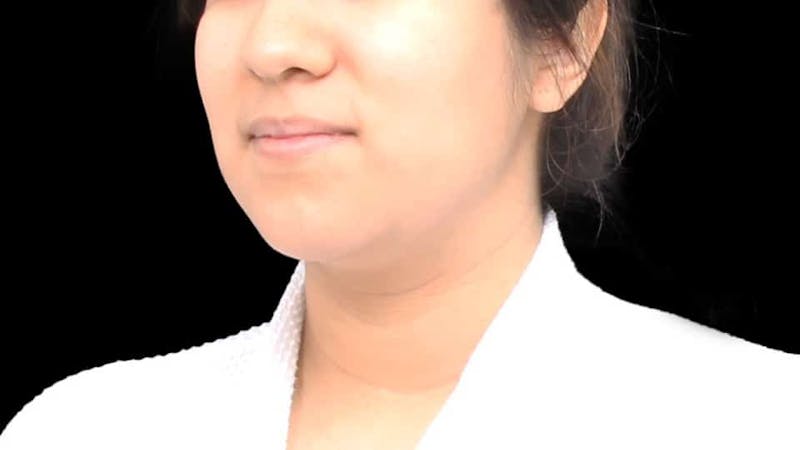 Chin Liposuction Before & After Gallery - Patient 366161 - Image 6