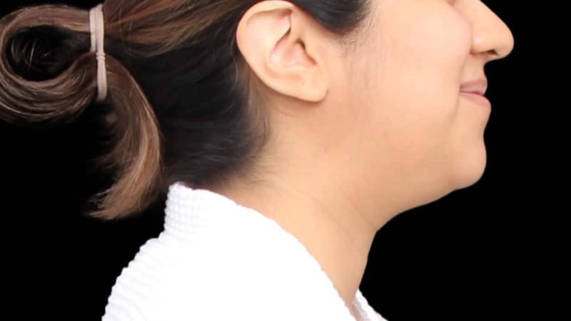 Chin Liposuction Before & After Gallery - Patient 366161 - Image 7