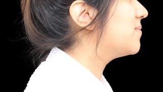 Chin Liposuction Before & After Gallery - Patient 366161 - Image 8