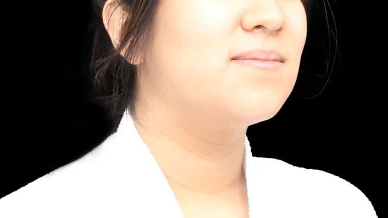 Chin Liposuction Before & After Gallery - Patient 366161 - Image 10