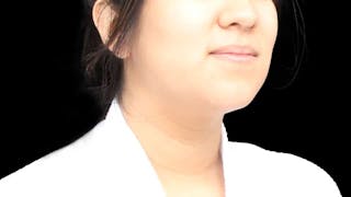 Chin Liposuction Before & After Gallery - Patient 366161 - Image 10