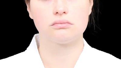 Chin Liposuction Before & After Gallery - Patient 338453 - Image 1