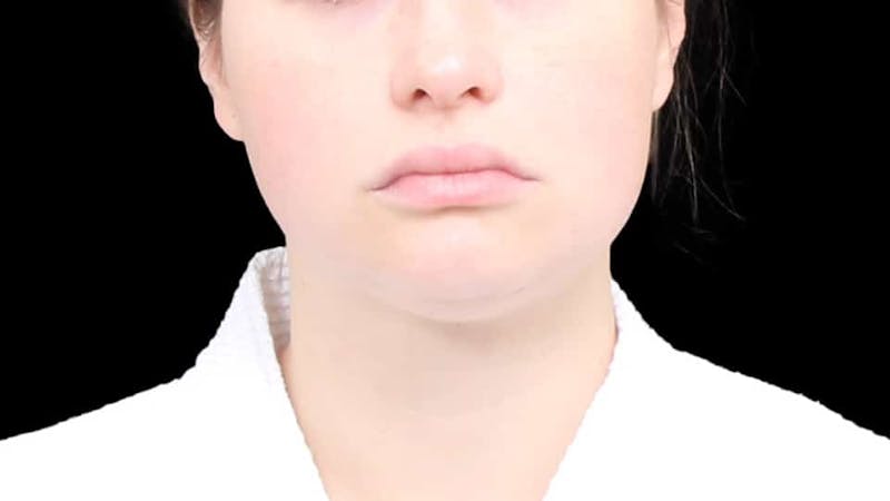 Chin Liposuction Before & After Gallery - Patient 338453 - Image 1