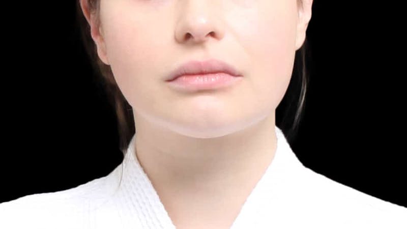 Chin Liposuction Before & After Gallery - Patient 338453 - Image 2