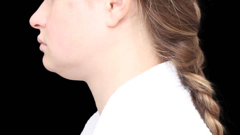 Chin Liposuction Before & After Gallery - Patient 338453 - Image 3