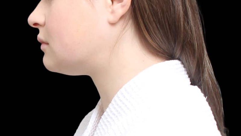 Chin Liposuction Before & After Gallery - Patient 338453 - Image 4
