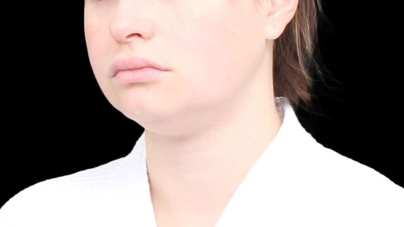 Chin Liposuction Before & After Gallery - Patient 338453 - Image 5