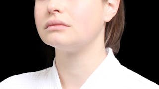 Chin Liposuction Before & After Gallery - Patient 338453 - Image 6