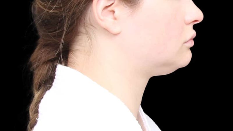 Chin Liposuction Before & After Gallery - Patient 338453 - Image 7