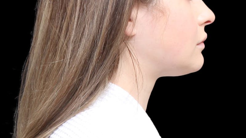 Chin Liposuction Before & After Gallery - Patient 338453 - Image 8