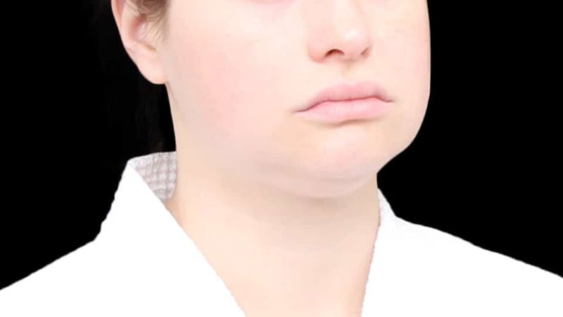 Chin Liposuction Before & After Gallery - Patient 338453 - Image 9