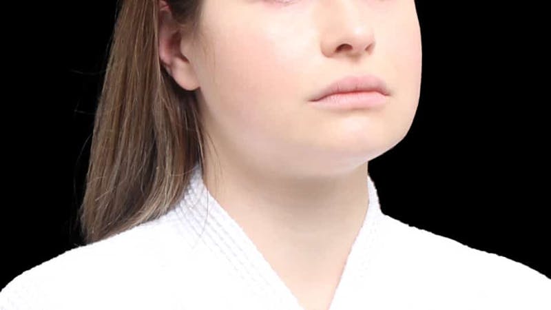 Chin Liposuction Before & After Gallery - Patient 338453 - Image 10