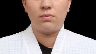 Chin Liposuction Before & After Gallery - Patient 364990 - Image 1