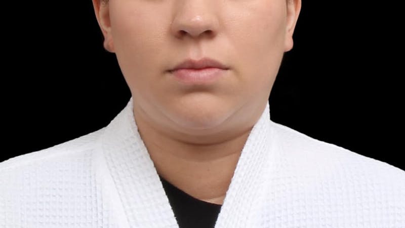 Chin Liposuction Before & After Gallery - Patient 364990 - Image 1