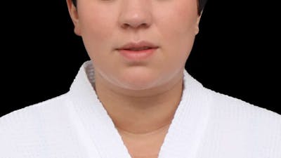 Chin Liposuction Before & After Gallery - Patient 364990 - Image 2