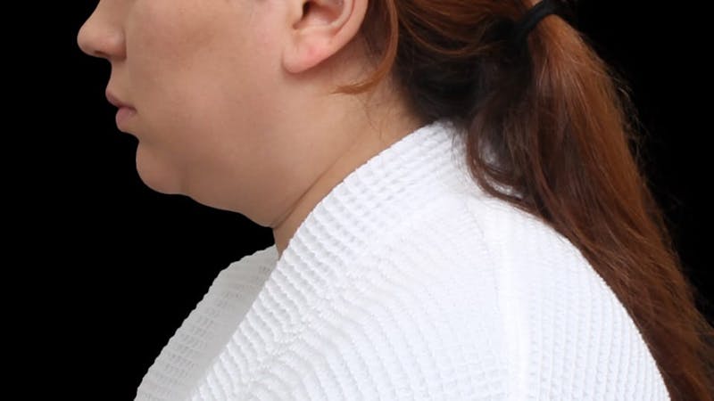 Chin Liposuction Before & After Gallery - Patient 364990 - Image 3