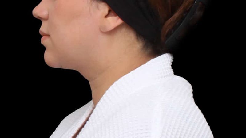 Chin Liposuction Before & After Gallery - Patient 364990 - Image 4