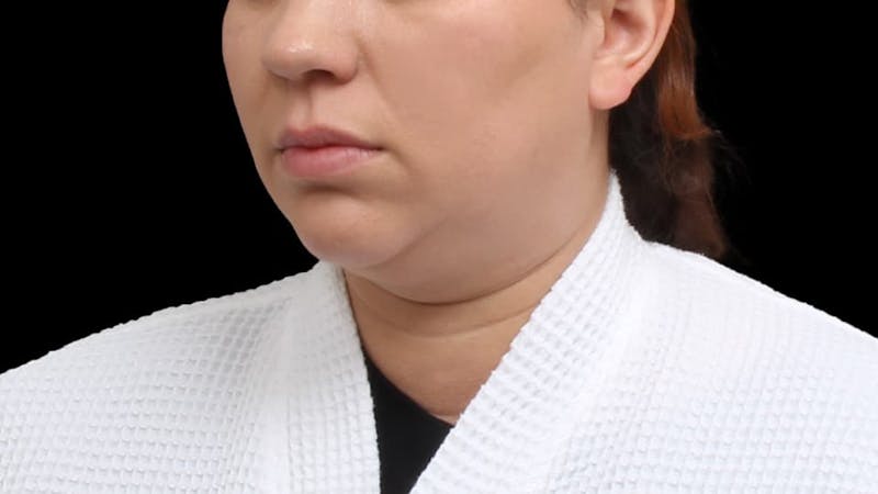 Chin Liposuction Before & After Gallery - Patient 364990 - Image 5