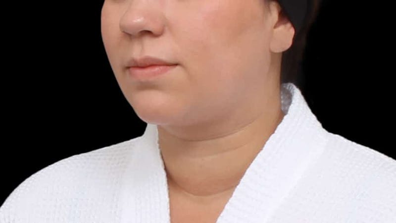 Chin Liposuction Before & After Gallery - Patient 364990 - Image 6