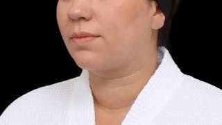 Chin Liposuction Before & After Gallery - Patient 364990 - Image 6