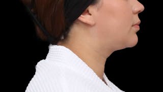 Chin Liposuction Before & After Gallery - Patient 364990 - Image 8