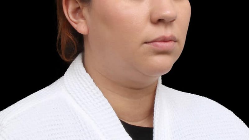 Chin Liposuction Before & After Gallery - Patient 364990 - Image 9