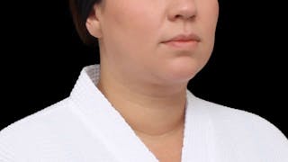 Chin Liposuction Before & After Gallery - Patient 364990 - Image 10