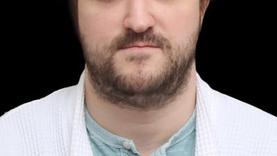 Chin Liposuction Before & After Gallery - Patient 648385 - Image 1