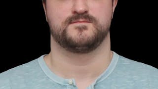 Chin Liposuction Before & After Gallery - Patient 648385 - Image 2