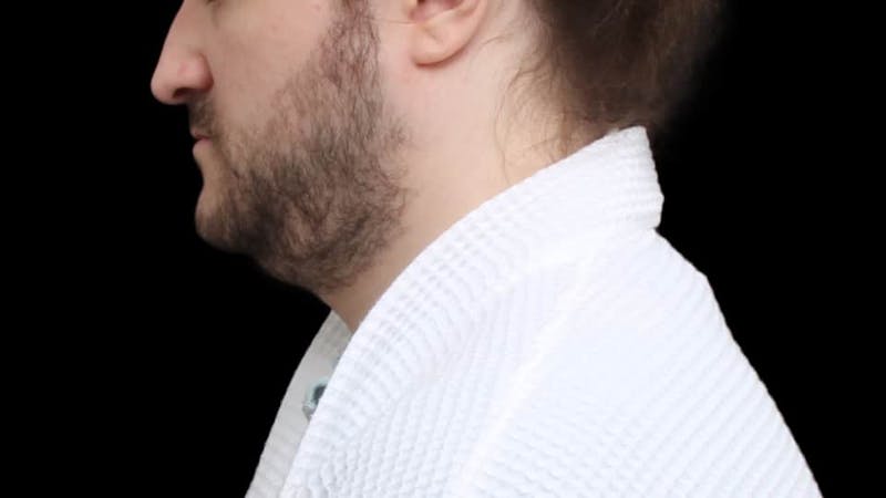 Chin Liposuction Before & After Gallery - Patient 648385 - Image 3
