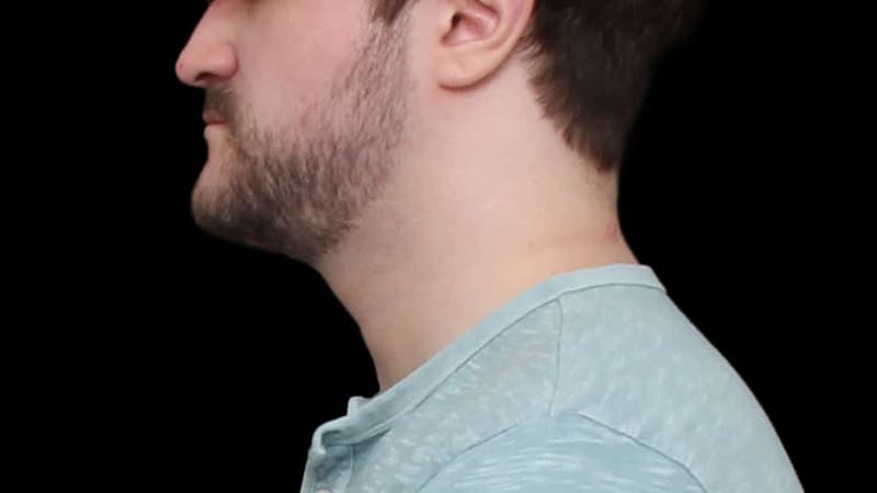 Chin Liposuction Before & After Gallery - Patient 648385 - Image 4