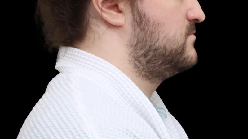 Chin Liposuction Before & After Gallery - Patient 648385 - Image 7