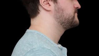 Chin Liposuction Before & After Gallery - Patient 648385 - Image 8