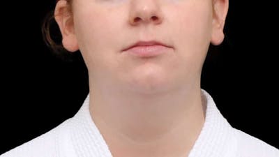 Chin Liposuction Before & After Gallery - Patient 332913 - Image 1