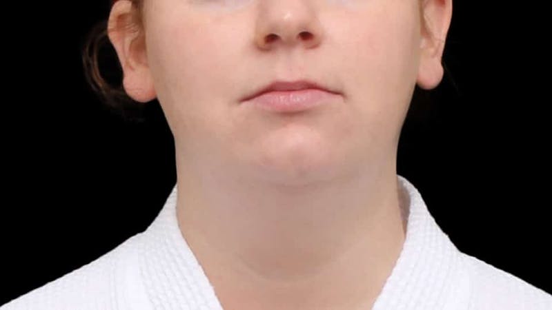 Chin Liposuction Before & After Gallery - Patient 332913 - Image 1