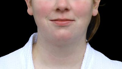 Chin Liposuction Before & After Gallery - Patient 332913 - Image 2