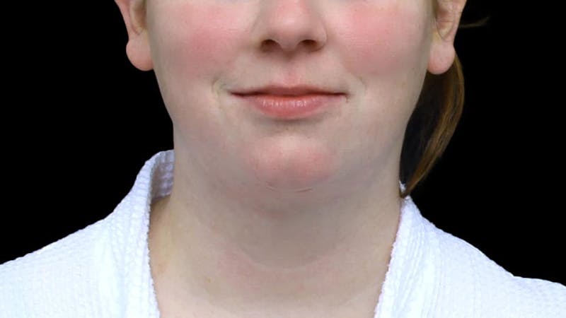 Chin Liposuction Before & After Gallery - Patient 332913 - Image 2