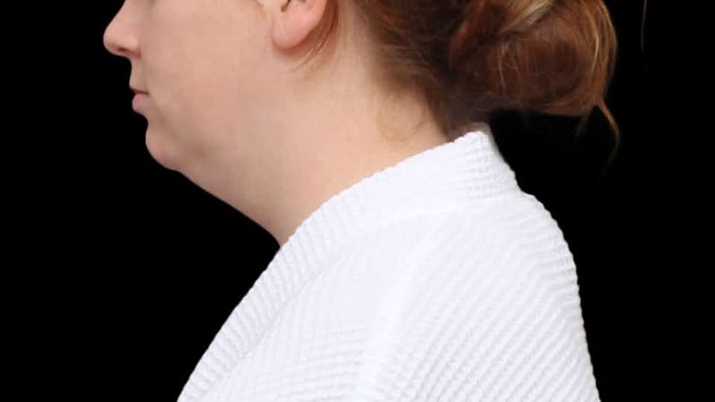 Chin Liposuction Before & After Gallery - Patient 332913 - Image 3