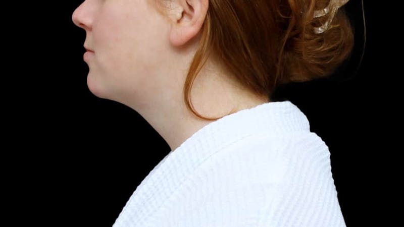 Chin Liposuction Before & After Gallery - Patient 332913 - Image 4