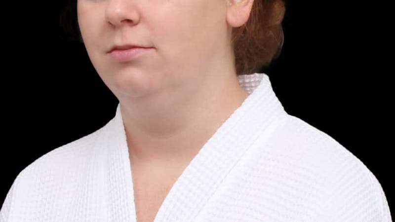 Chin Liposuction Before & After Gallery - Patient 332913 - Image 5