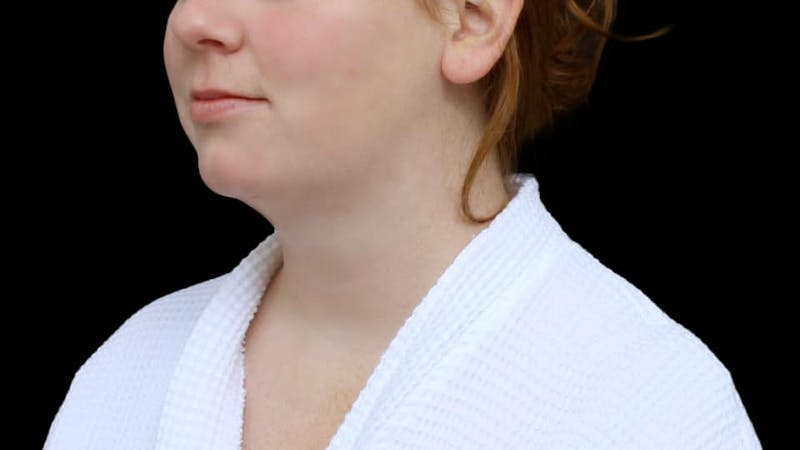 Chin Liposuction Before & After Gallery - Patient 332913 - Image 6