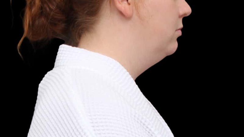 Chin Liposuction Before & After Gallery - Patient 332913 - Image 7