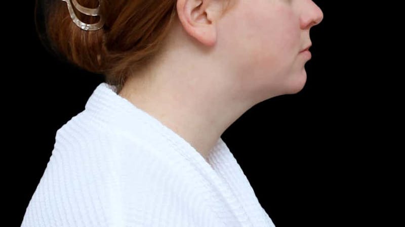 Chin Liposuction Before & After Gallery - Patient 332913 - Image 8