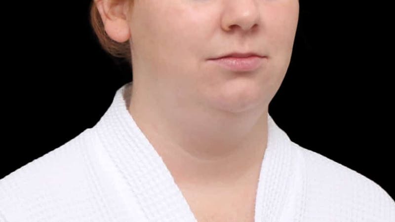 Chin Liposuction Before & After Gallery - Patient 332913 - Image 9