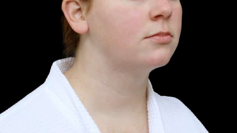 Chin Liposuction Before & After Gallery - Patient 332913 - Image 10
