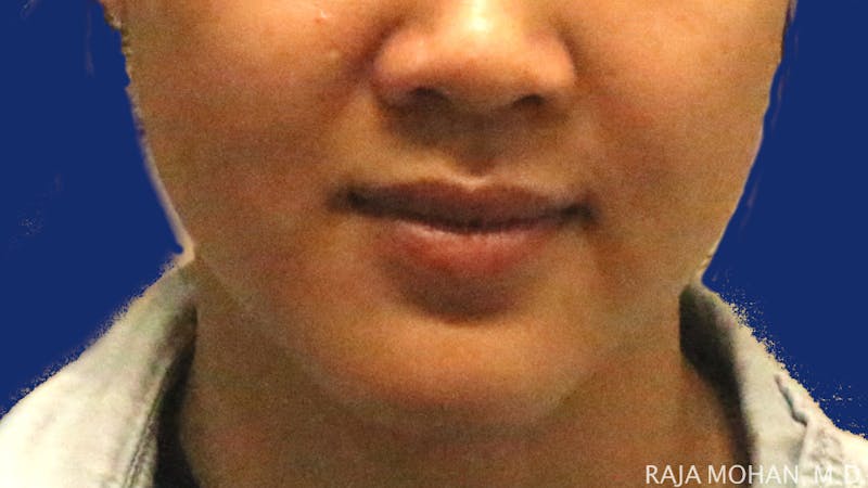 Buccal Fat Pad Removal Before & After Gallery - Patient 122420 - Image 1